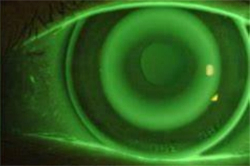 角膜塑形镜32 角膜塑形镜32