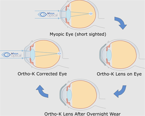 角膜塑形镜前后对比 角膜塑形镜前后对比