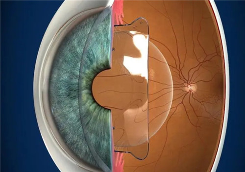 晶体植入近视手术模拟图 晶体植入近视手术模拟图