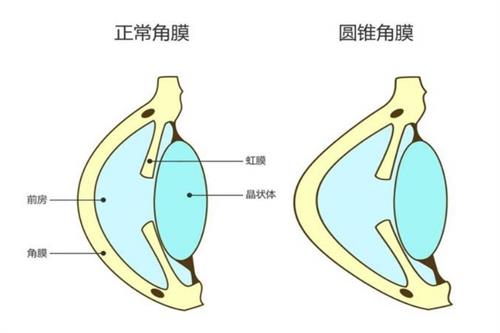 圆锥角膜初期散光能增加多少？散光与圆锥角膜有什么关系？