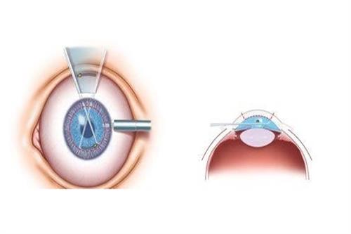 圆锥角膜手术的部位