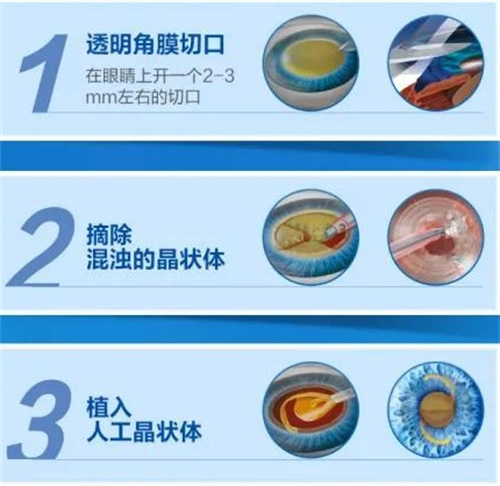 做了晶体植入后眼睛出现裂孔打激光需要取晶体吗？