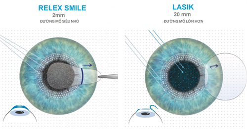 全飞秒跟半飞秒对比 全飞秒跟半飞秒对比