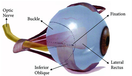 后巩膜加固术遭罪吗？会导致视野缺损吗？还会导致哪些问题？
