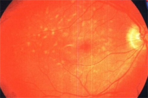 眼底黄斑 眼底黄斑
