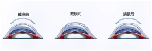 角膜塑形镜佩戴