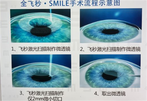 临沂华厦眼科全飞秒手术过程图解