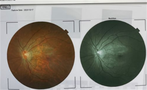 太原爱维视眼科检查结果图片 太原爱维视眼科检查结果图片